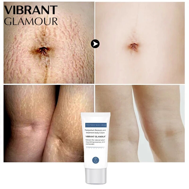 VIBRANT GLAMOUR Stretch marks remover Body Repair cream set Pregnancy Scars Obesity lines scar Anti Aging Firming Skin Care 2pcs