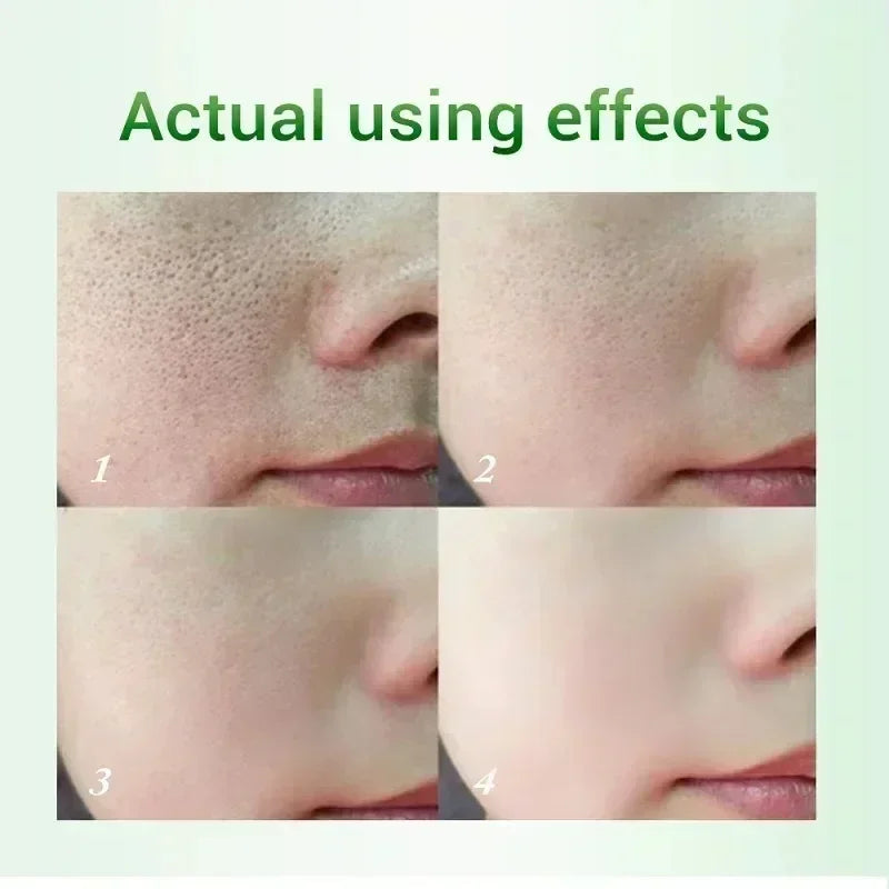Salicylic Acid Pores Shrink Refining Cream Repair Large Open Pore Removal Black Dots Blackhead Acne Marks Facial Skin Care Serum