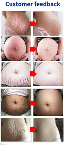 Stretch Marks Treatment Repair Essential Oil Skin Care Cream For Maternity Remover Anti-Wrinkle Slackline For Pregnant Body Oils