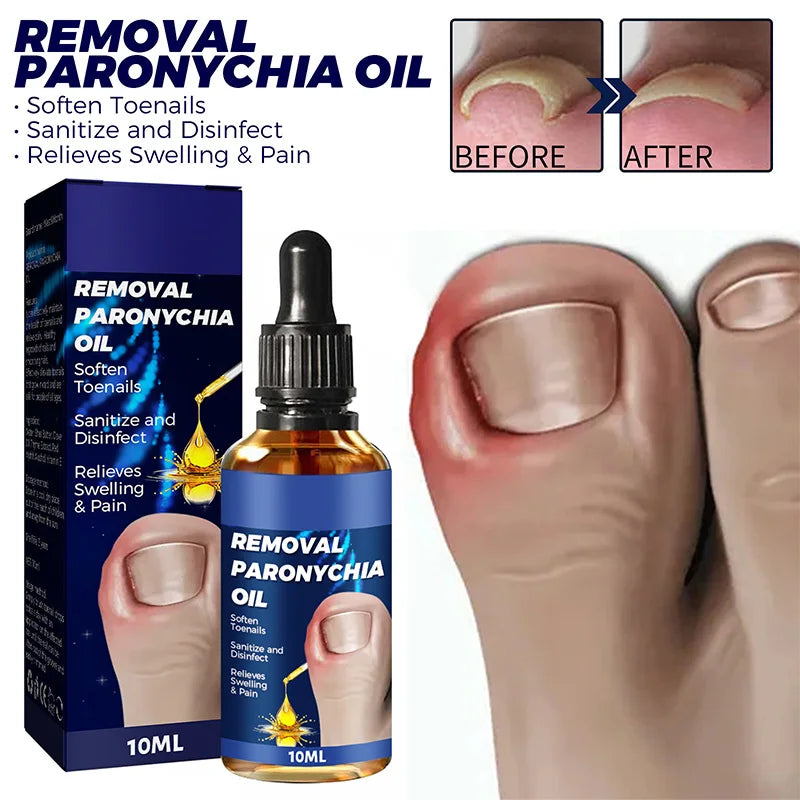 Toenailcare Removal Paronychia Oil Ingrown Toenail Treatment Nail Renewal Liquid Bad Nail Thicken Nail Soft Nail Repair Solution
