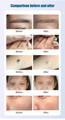 est Sellers Laser Beauty Machine Portable Q-switch ND YAG Laser Tattoo Removal Pigmentation Removal Carbon Peeling Machine