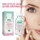 OUHOE Salicylic Acid Akne-Trocknungs-Lotion Salicylsäure Entfernt tief Akne Repariert feuchtigkeitsspendendes Gesichtsserum