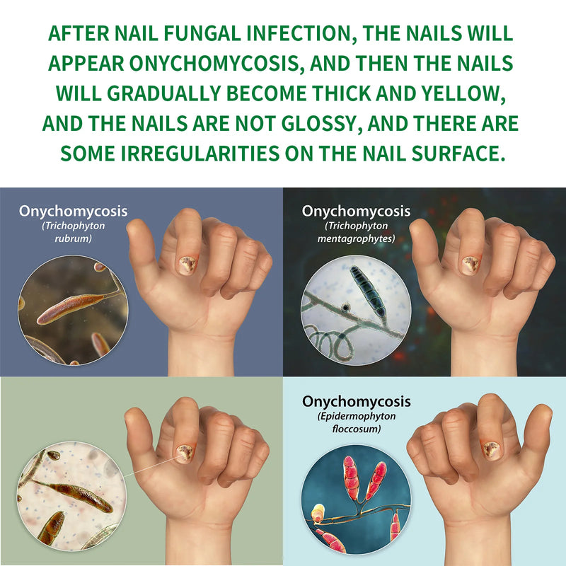 1-5Pcs Nail Fungal Treatment Device 7 Days Repair Oil Foot Toe Essence Anti Infection Paronychia Ginger Onychomycosis Gel Care