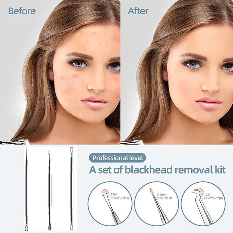 Beauty Salon Special Remove Acne Fat Particle Needle Tool Ultra-fine Cell Pimple Blackhead Whitehead Clip Black Dot Pore Cleaner