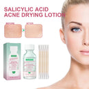 OUHOE Salicylic Acid Akne-Trocknungs-Lotion Salicylsäure Entfernt tief Akne Repariert feuchtigkeitsspendendes Gesichtsserum