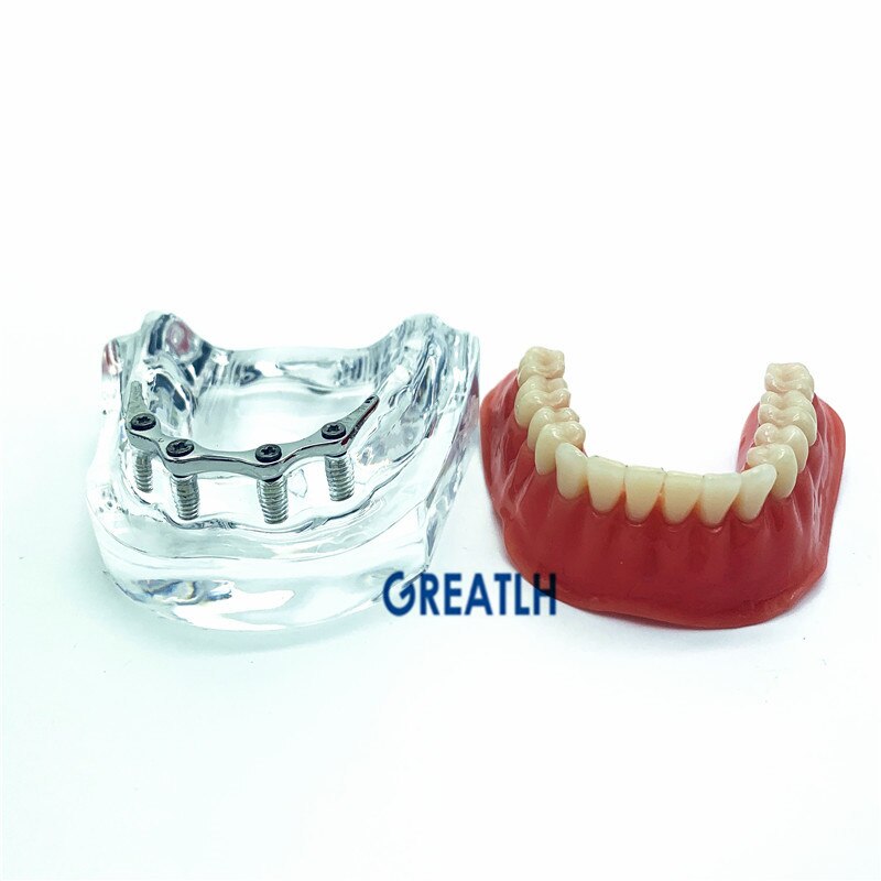 Modelo de implante de reparación de dientes con barra dorada, dentadura postiza, modelo mandibular, modelo de enseñanza Dental
