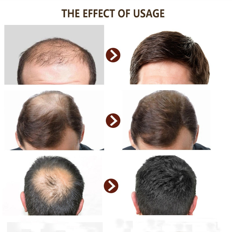 PURC, 2 uds., juegos de productos para el crecimiento rápido del cabello, Spray para el crecimiento del cabello, tratamiento para el cuero cabelludo, extracto de jengibre, previene la pérdida de cabello para hombres y mujeres