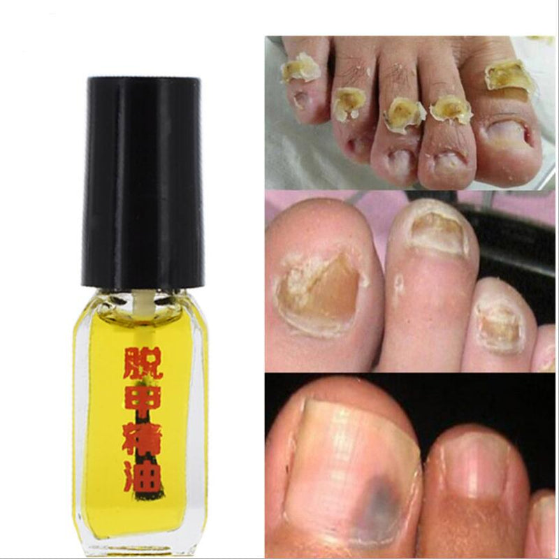 New 2021 3 Days Effect Treatment Removal of onychomycosis Paronychia Anti oil Fungal Nail Infection Toe Nail Fungus oil